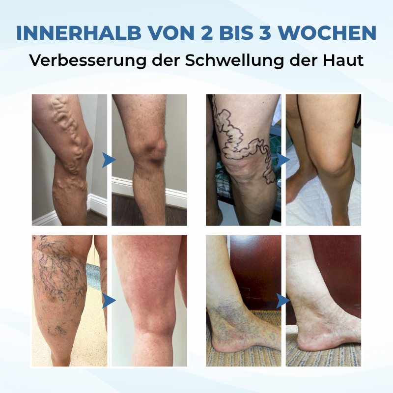 Timilk® TheraVein Kräuter-Spray gegen Krampfadern