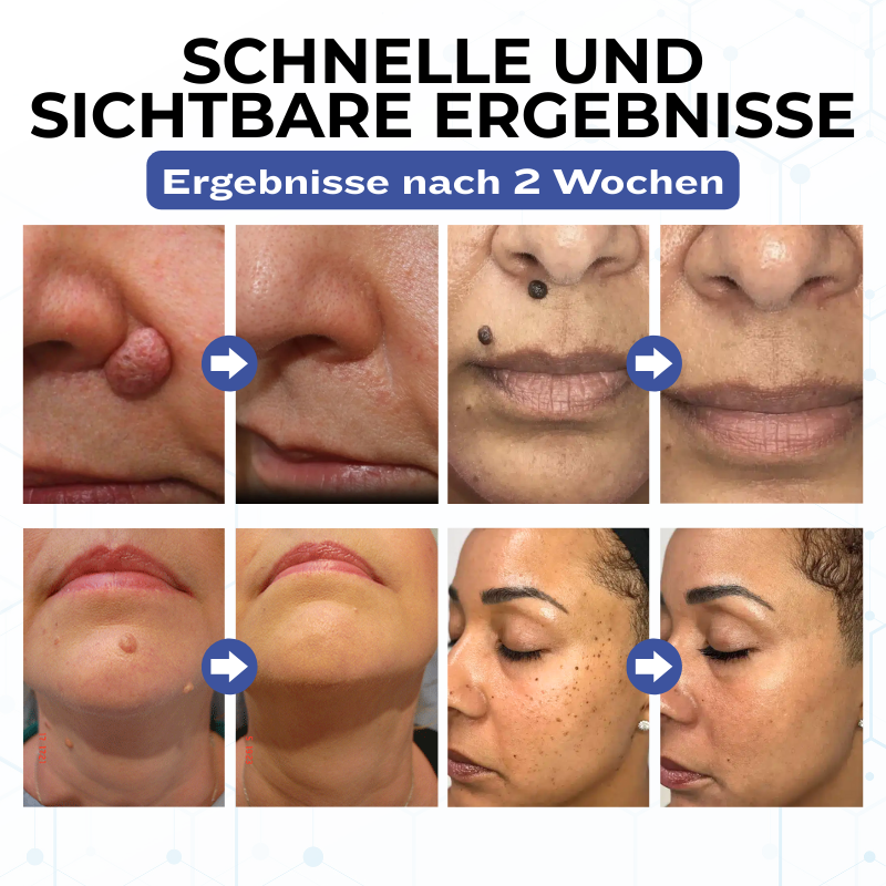 Timilk® VanishPro Hautflecken-Entfernungscreme