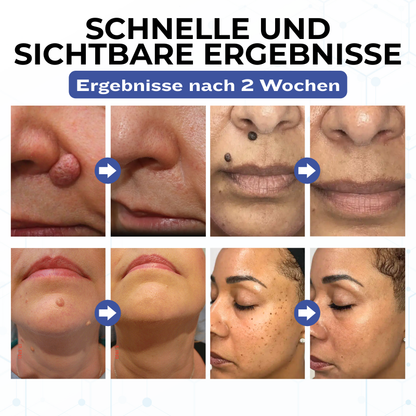 Timilk® VanishPro Hautflecken-Entfernungscreme
