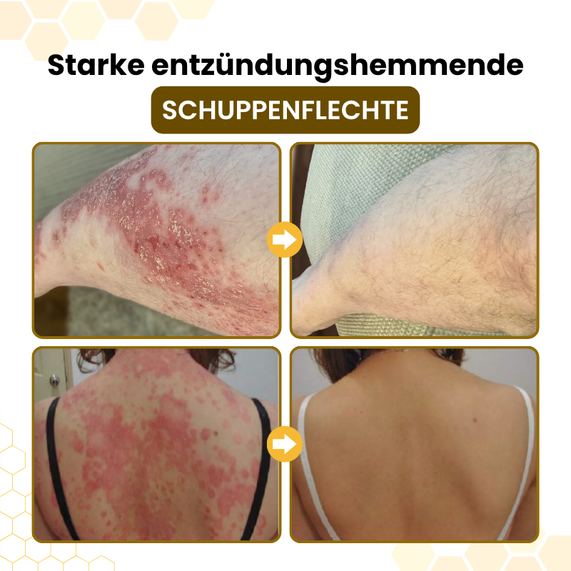 Timilk® PsoriaSoothe Fortschrittliche Bienengift Haut-Regenerationscreme