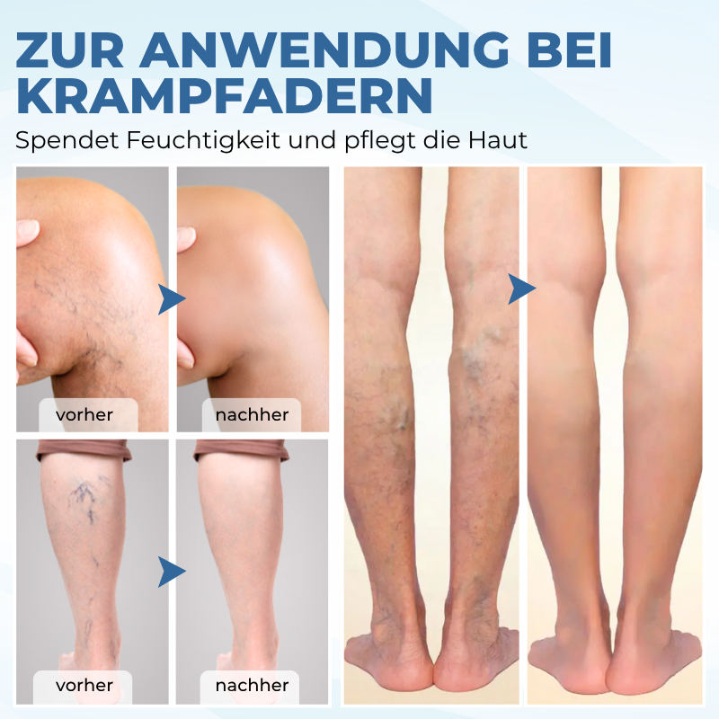 Timilk® TheraVein Kräuter-Spray gegen Krampfadern
