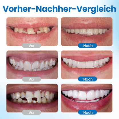 Timilk® SmileMend Zahnreparatur-Füllungsset🔥
